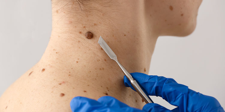 Mole Removal: What is it,  Happens, How It’s Done, and More