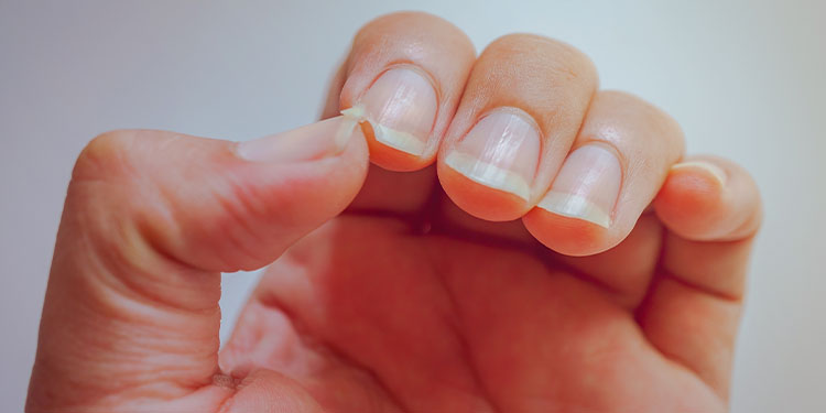 Ridges in Nails- Horizontal, Vertical, Causes & Treatment