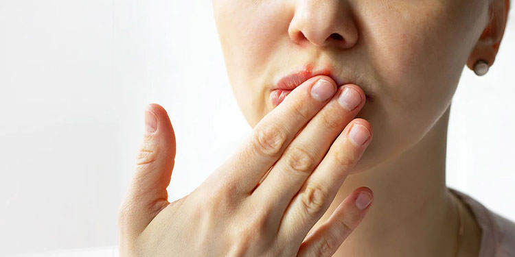 What Causes Chapped Lips and How to Treat Them?