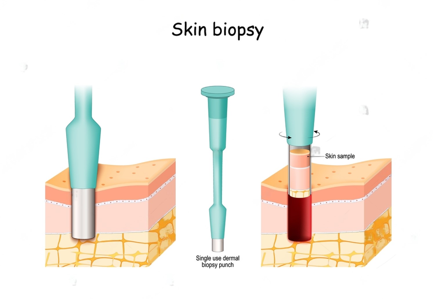 Skin Biopsy Test: Purpose, Procedure, Complications, Recovery