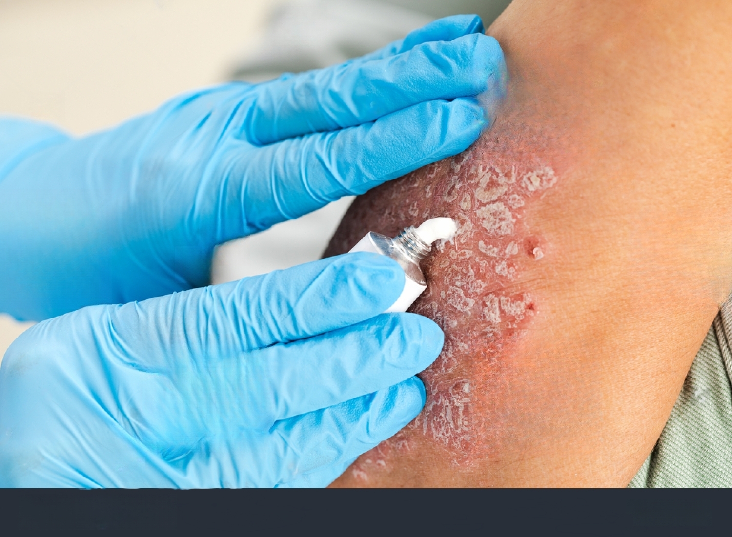 The Importance of Adherence to Treatment in Psoriasis