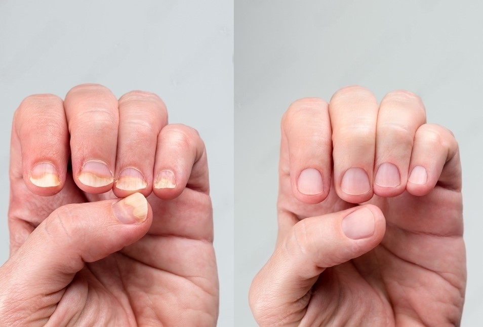 Severe psoriasis of the fingernails showing subungual hyperkeratosis,... |  Download Scientific Diagram