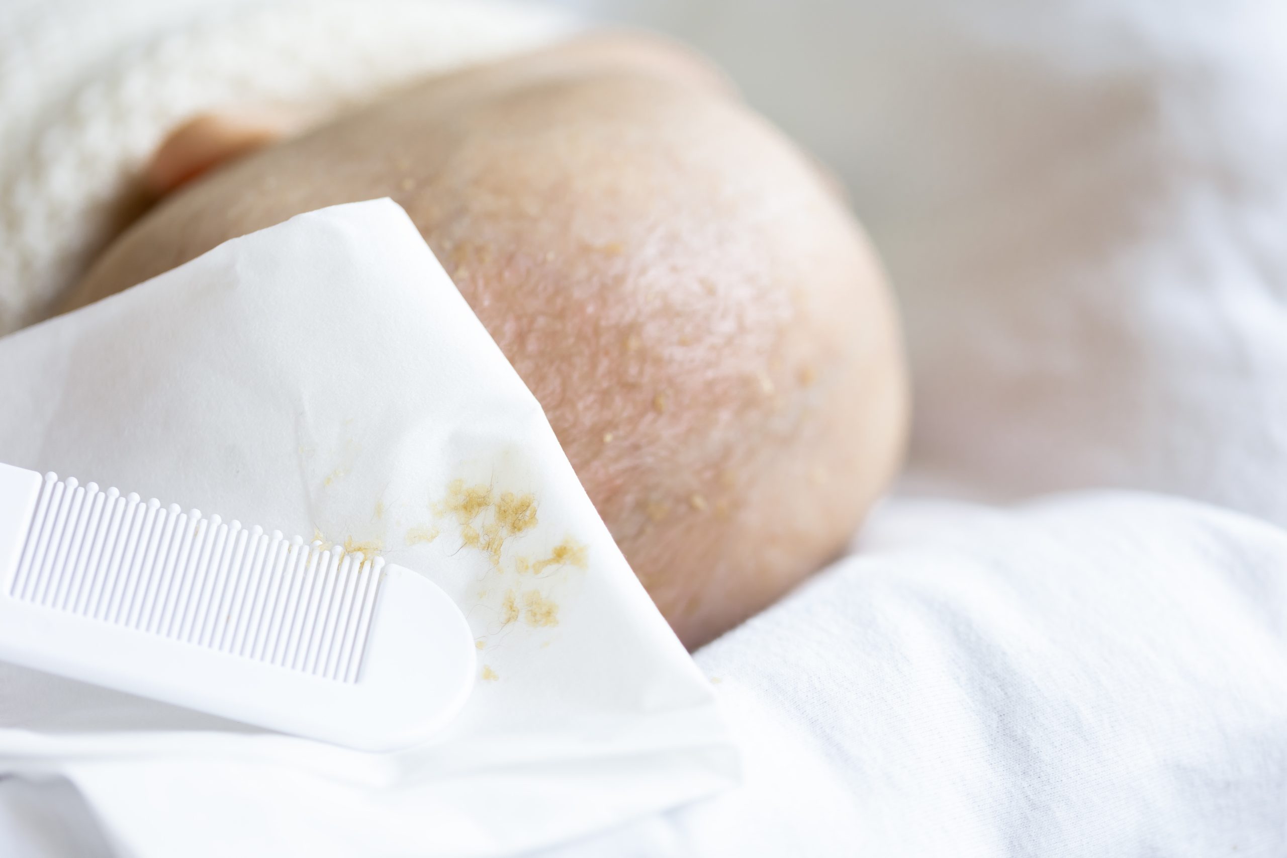 Cradle Cap (Seborrheic Dermatitis) in Infants: Causes & Symptoms
