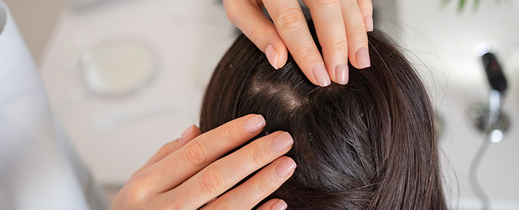 Scalp Psoriasis vs Dandruff_ Symptoms, Pictures, and Causes